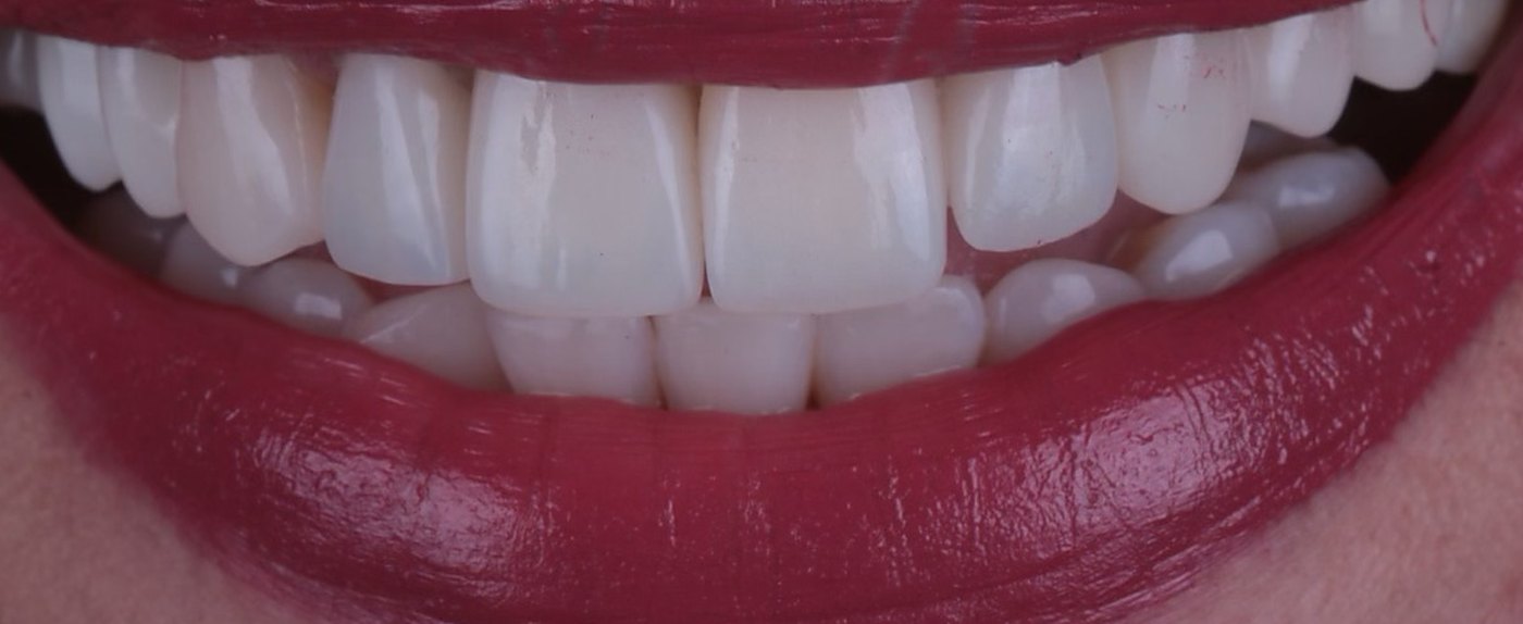 Sonrisa después del tratamiento: dientes parejos, de color uniforme y con la línea de la encía nivelada