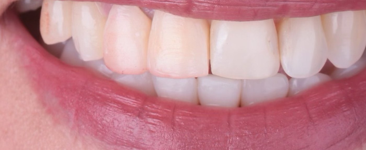 Sonrisa antes del tratamiento: dientes desgastados, de tono amarillento y bordes irregulares