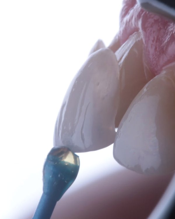 Detalle de una carilla de porcelana antes de cementarla